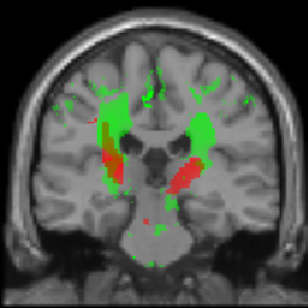 Irreversible tissue loss seen within 40 days of spinal cord injury