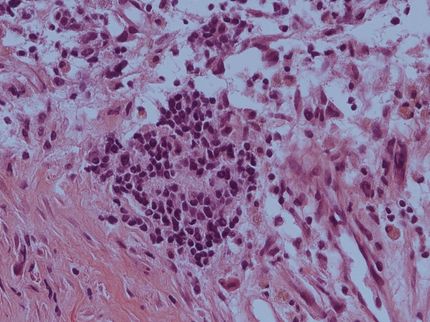 Tumoren auf Entzug: Aminosäuremangel lässt kindliche Tumoren schrumpfen