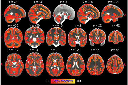 Magnetic resonance imaging shows brain inflammation in vivo for the first time