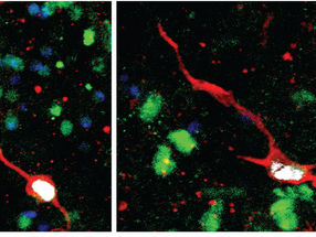 Zwei Beispiele für neugeborene unreife Dentate-Granula-Neuronen in den chirurgischen Proben des adulten menschlichen Hippocampus in Kultur, markiert mit überlappenden Markersignalen von unreifen Neuronen (rot), Dentate-Granula-Neuronen (grün), Zellkernen (blau) und neugeborenen Zellen, die mit synthetischen Nukleosidanaloga markiert sind (weiß).