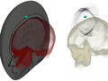 Left: A hexahedral finite-​element mesh of the skull and the brain. Right: A snapshot of the resulting ultrasound simulation. The blue disk in both images represents the ultrasound source.