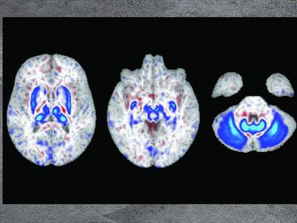 Sur ces scans du cerveau, les zones bleues indiquent les régions présentant une accumulation de fer chez les personnes possédant deux copies du gène de risque de l'hémochromatose. Ces régions jouent également un rôle dans le mouvement.