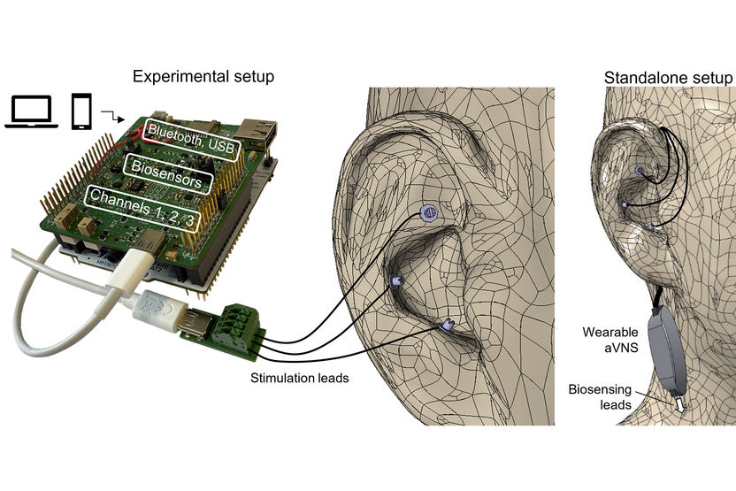 Stimulation du nerf vague dans le traitement de la dépression -  ScienceDirect