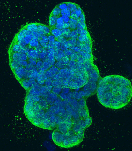 Keeping aggressive cancer cells in check - An astonishing observation