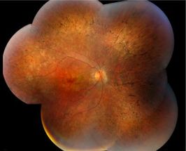 New urine test could diagnose eye disease