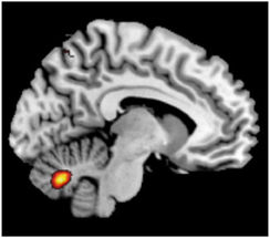 Wie Gedächtnis und Schizophrenie zusammenhängen