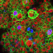 How brain tumors develop from stem cells
