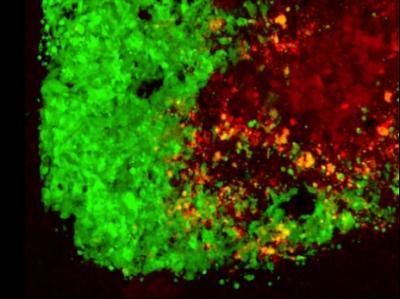 Tumor cells