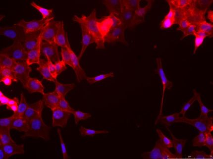 Dickdarmkrebs MDCForscher identifizieren genetischen Fingerabdruck für Metastasenbildung