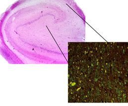 Rasterfahndung nach Epilepsie-Genen