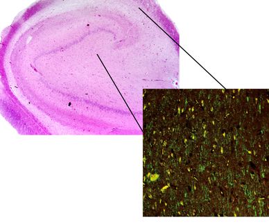 Rasterfahndung nach Epilepsie-Genen