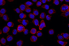 Zellen aus einem B-Zell-Tumor