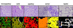 Subtypenerkennung für verschiedene Formen des Adenokarzinoms mithilfe der Spektralen Histopathologie