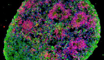Making 'miniature brains' from skin cells to better understand autism