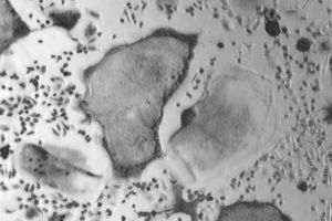 proliferation tumor tissue cathepsin