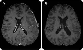 brain tissue chemoradiation