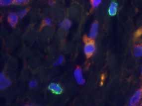 Lebertumorzelle mit den tumorbekämpfenden Immunzellen IL 33 und CD8+