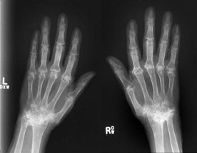 rheumatiod arthritis gene regulation