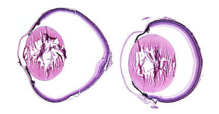 Buphtalmie Kurzsichtigkeit