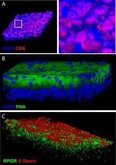 macular degeneration stem cells