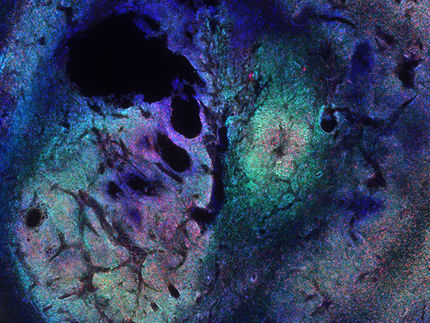 Signaling Pathway Suppresses Brain Tumors