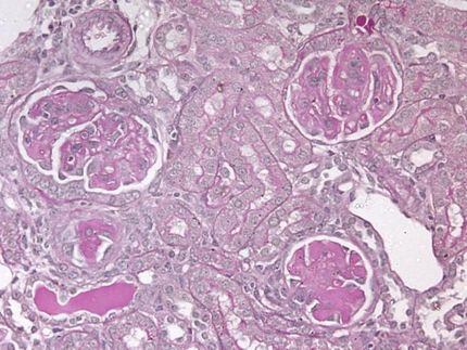 kidney disease