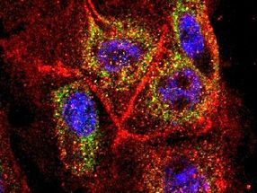Krebszellen aus der Bauchspeicheldrüse