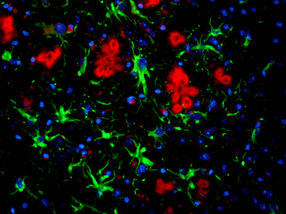 Alzheimer: Neues stark neurotoxisches Peptid entdeckt