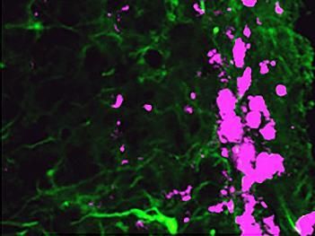 Researchers use skin cells to kill cancer