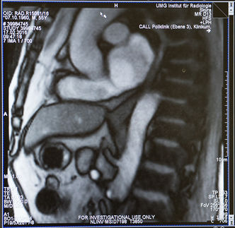 Speiseröhre und Übergang zum Magen