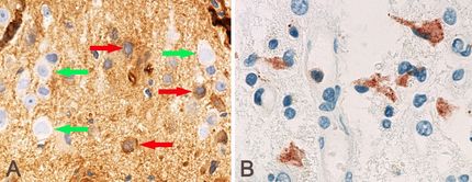 Immune system involved in rare epilepsy