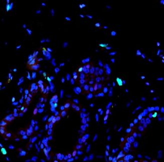 New predictive tool for assessing breast cancer risk