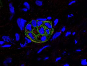 Cell death mechanism may, paradoxically, enable aggressive pancreatic cells to live on