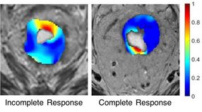 Researchers developing GPS for rectal cancer surgery