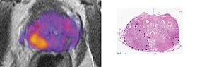 Imaging biomarker distinguishes prostate cancer tumor grade