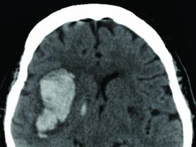 Standard blood pressure target is sufficient for treating some strokes