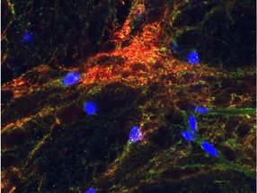 Parkinson: Mögliche Ursache für gestörte Kommunikation zwischen Gehirnzellen gefunden