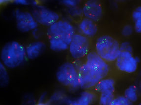 Neuer Biomarker für Krebsimmuntherapie?