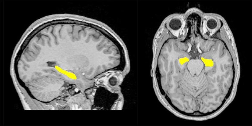 © Neuropsychiarty and Brain Imaging Group, Basel