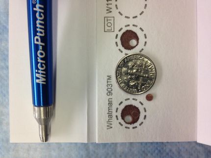 New blood spot test used internationally in fight against HIV