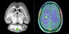 Akute Entzündungen im Gehirn bei Multipler Sklerose sichtbar gemacht