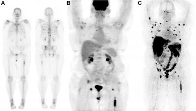 Novel anti-PSMA imaging agent quickly identifies prostate cancer lesions