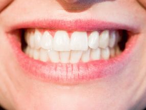 Genetische Defekte im Zahnschmelz begünstigen die Bildung von Karies