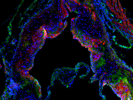 La molécula cortistatina reduce el número y tamaño de las placas de grasa en el sistema cardiovascular