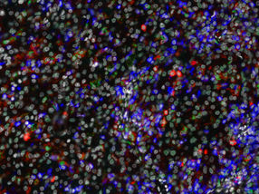 Umfassende Kartierung der Immunzellen beim Nierenkrebs