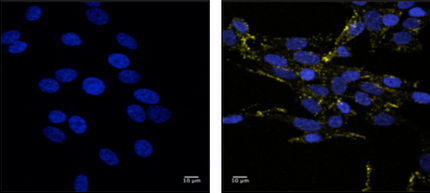 Molekulares Bindeglied zwischen Parkinson und Schwarzem Hautkrebs entdeckt