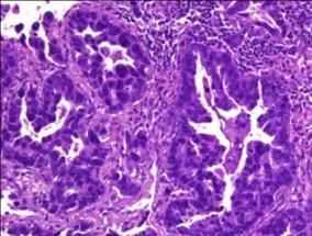 Nuevas estrategias epigenómicas en el manejo clínico del cáncer de origen desconocido