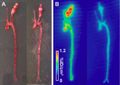 Imaging tracer allows early assessment of abdominal aortic aneurysm risk