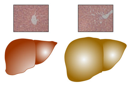 Trigger for Fatty Liver in Obesity