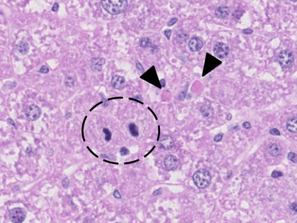 Wie Leberkrebs entsteht